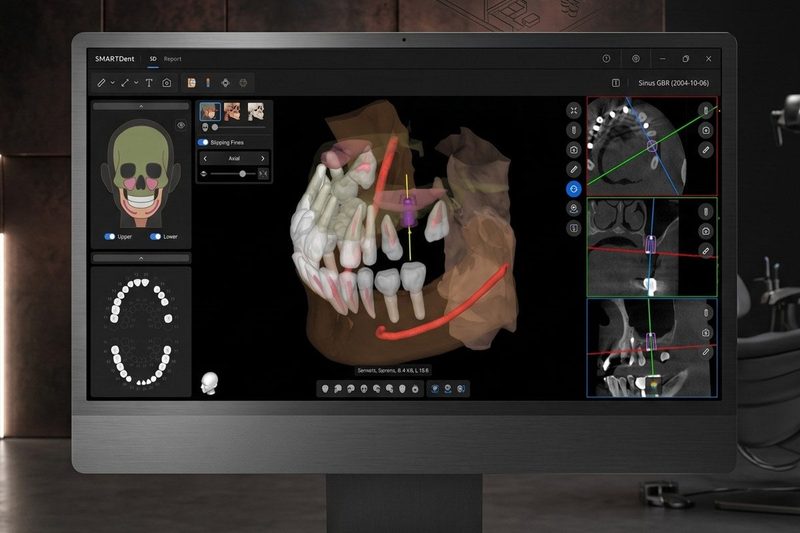 インプラント模擬手術の3D設計画面