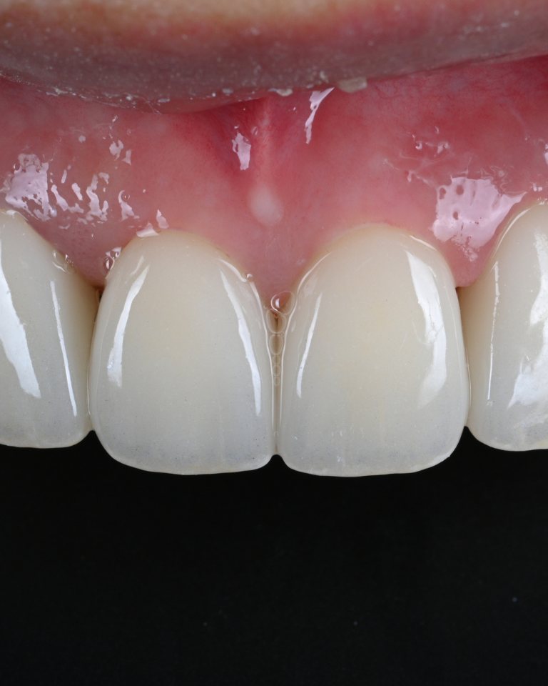 セラミックの前歯（クローズアップ）— Atelier Veneers 延世セブランス歯科