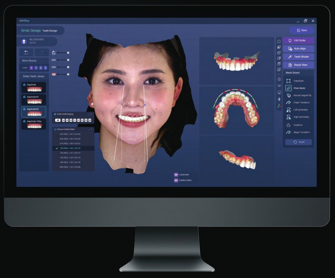3Dフェイススキャンによるスマイルライン分析 — RAYFace